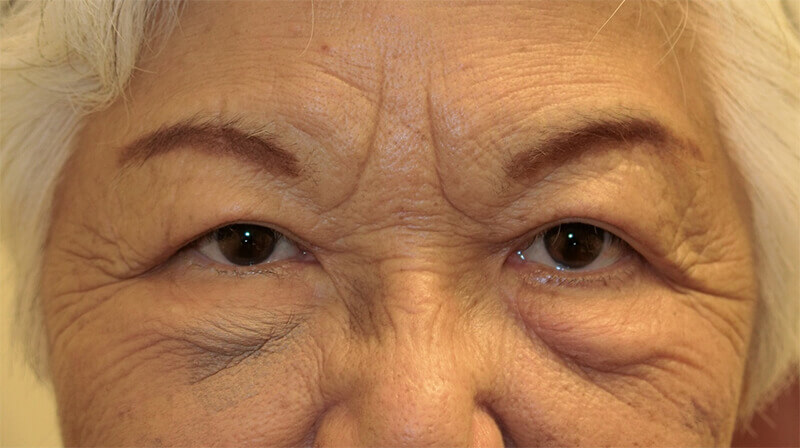 Upper eyelid surgery after