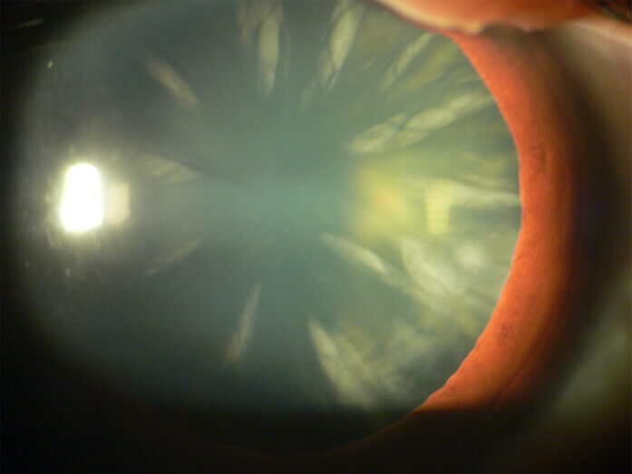 Cataract close up